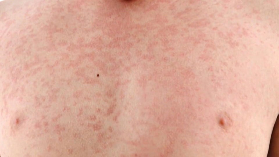 Could Canada lose its measles elimination status over soaring cases across the country?
