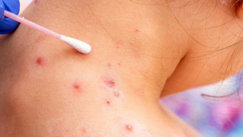 CTV National News: How the measles are spreading across Canada