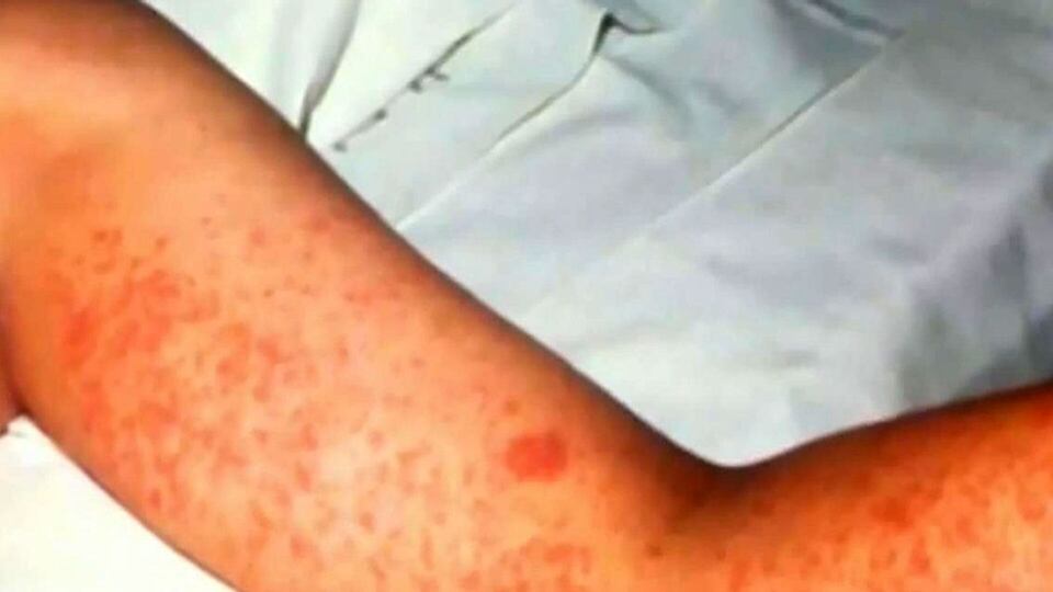 Measles case count in B.C. rises to 102