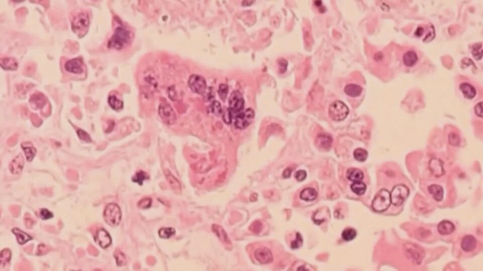 Measles case in Sussex, N.B.