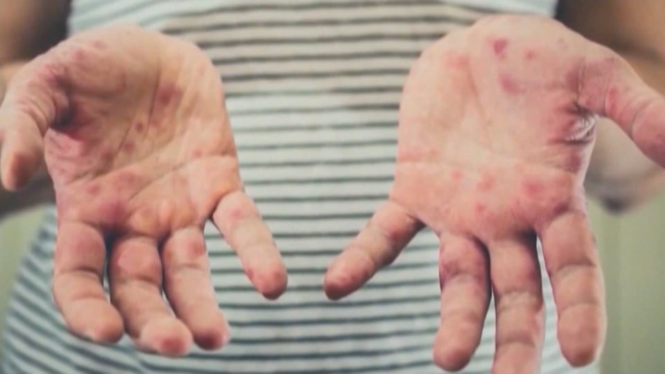 Another measles cases in northern Ont.