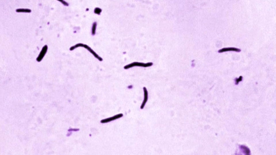 Toronto tuberculosis cases reached record levels in 2024